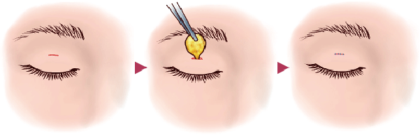 埋没法イラスト